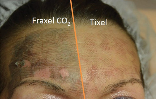 Tixel Vs. C02 laser - Love Skin Botanicals